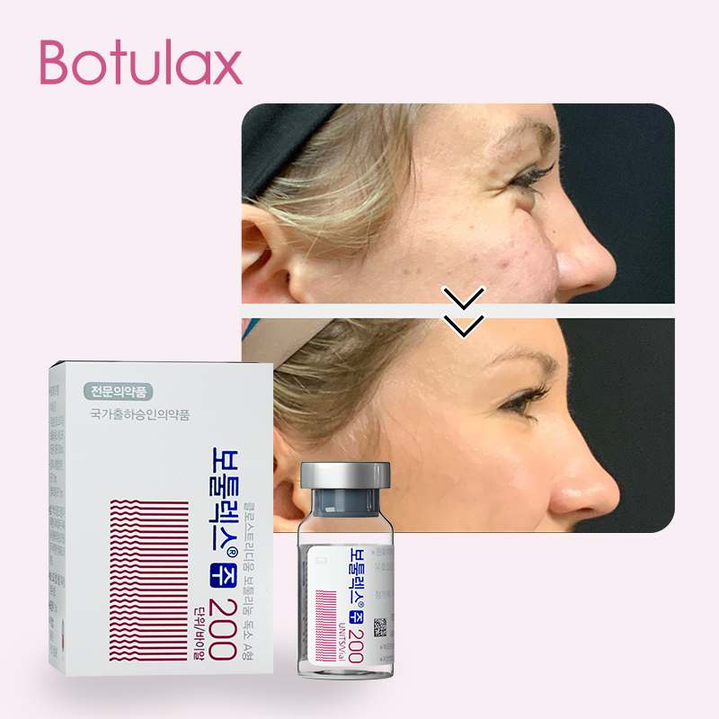 Botulinum Toxin crows feet